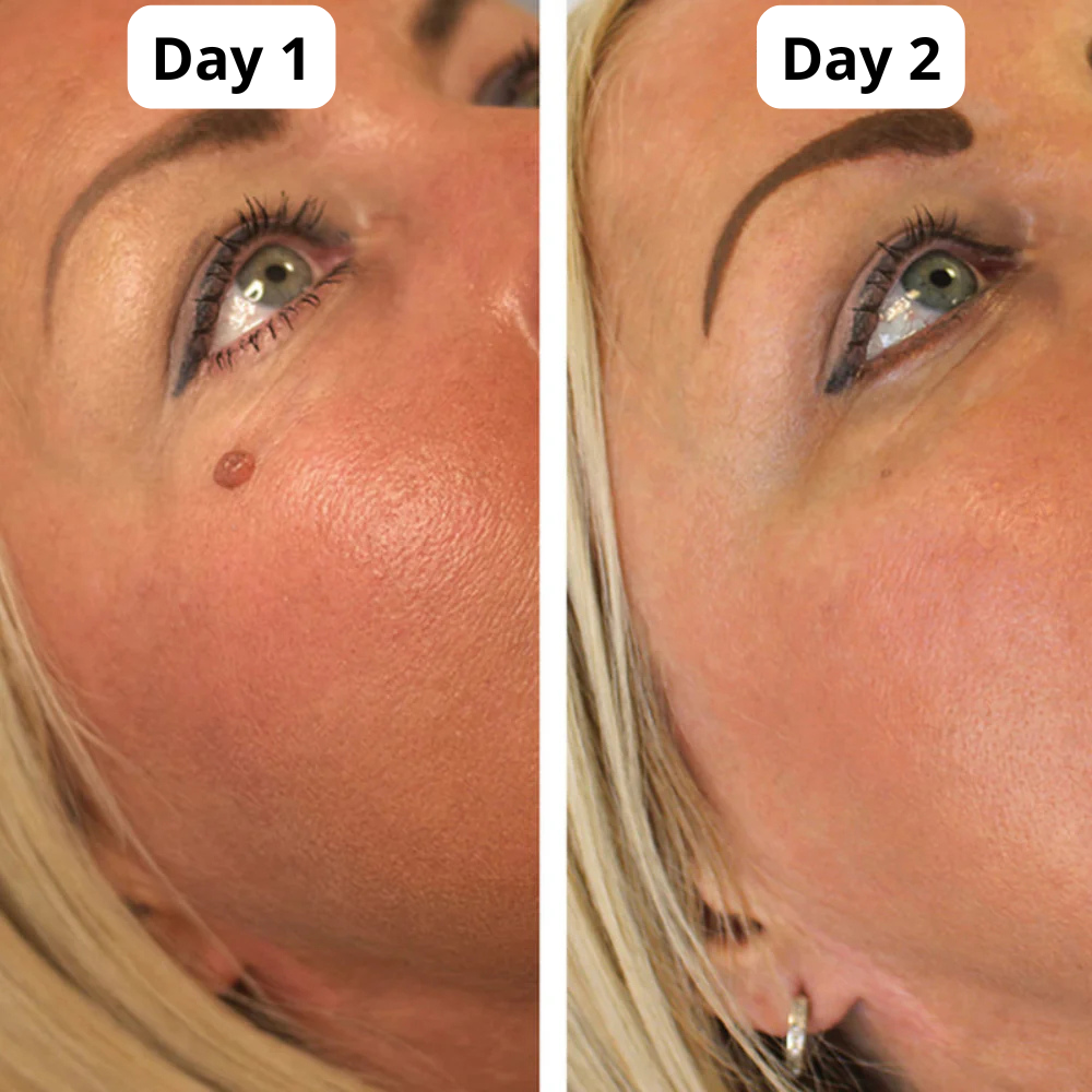 Auto TagBand® - Skin Tag Removal Kit