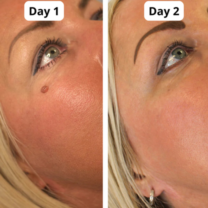 Auto TagBand® - Skin Tag Removal Kit